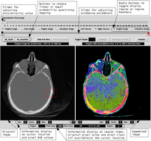 GUI for displaying hierarchical segmentation results to detect stroke lesions