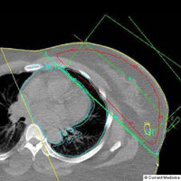 Radiotherapy image